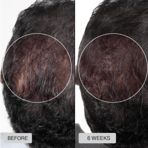 đ„HOT SALE 49% OFFđ„Red light hair growth CAP â Regrow Thicker Hair in 90 Days