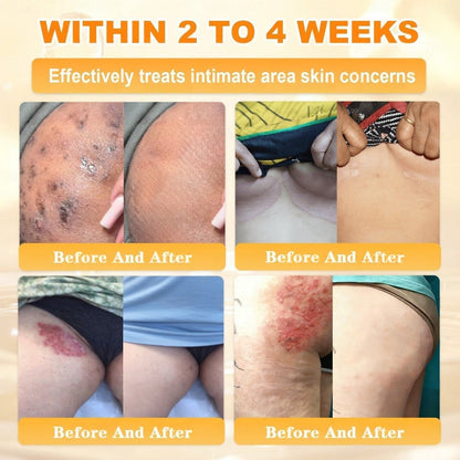 🐝🔥FDA Approved| Ptyalial® Bee toxin Skin Restoration Cream (Anti-aging, Hydrating, Skin Repair, Even Tone, Acne and Dark Spot Treatment, Wart and Mole Removal, Psoriasis Relief)