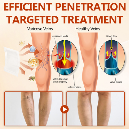 🔥 LIMITED SPECIAL OFFER🔥Acezozla® VeinRepair Microneedle Patch Roll (Advanced Microneedle Vein Repair Patch for Bulging Veins, Swelling, Heavy Legs & Daily Leg Discomfort)