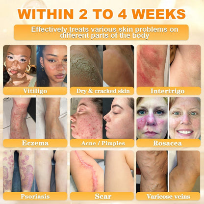 🐝🔥FDA Approved| Ptyalial® Bee toxin Skin Restoration Cream (Anti-aging, Hydrating, Skin Repair, Even Tone, Acne and Dark Spot Treatment, Wart and Mole Removal, Psoriasis Relief)